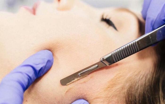 Dermaplaning beneficios o consecuencias